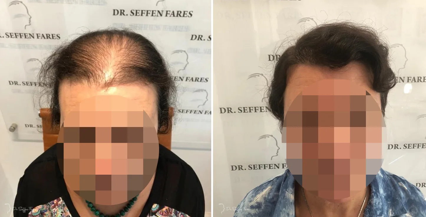 Patient 37, before and after hair transplant, view 4