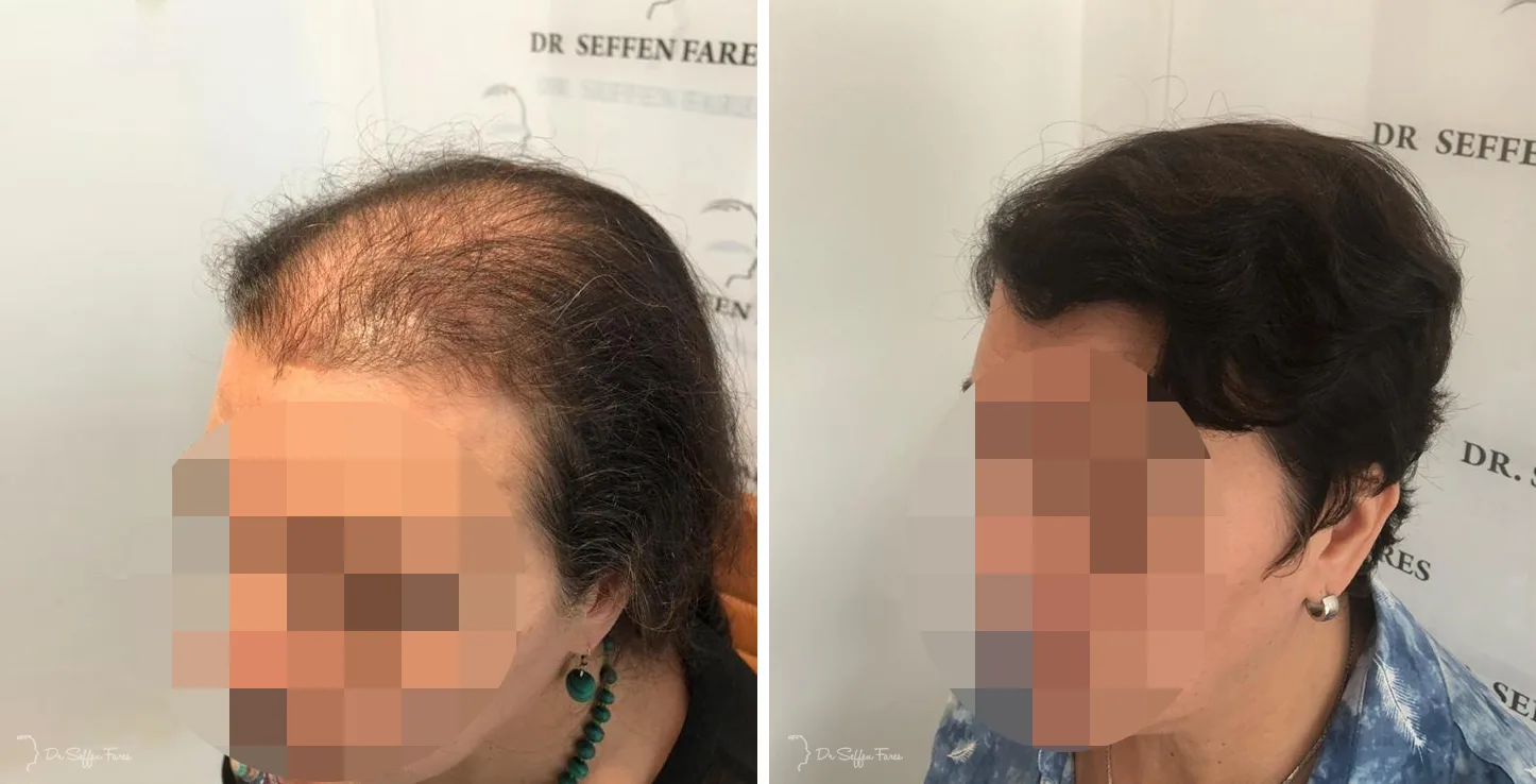 Patient 37, before and after hair transplant, view 1