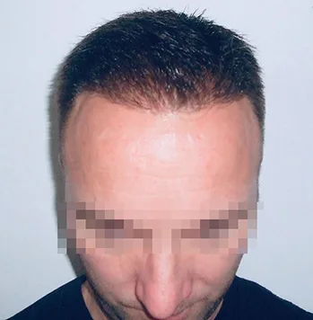 Patient 38, après greffe de cheveux