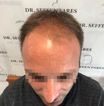 Patient 38, avant greffe de cheveux