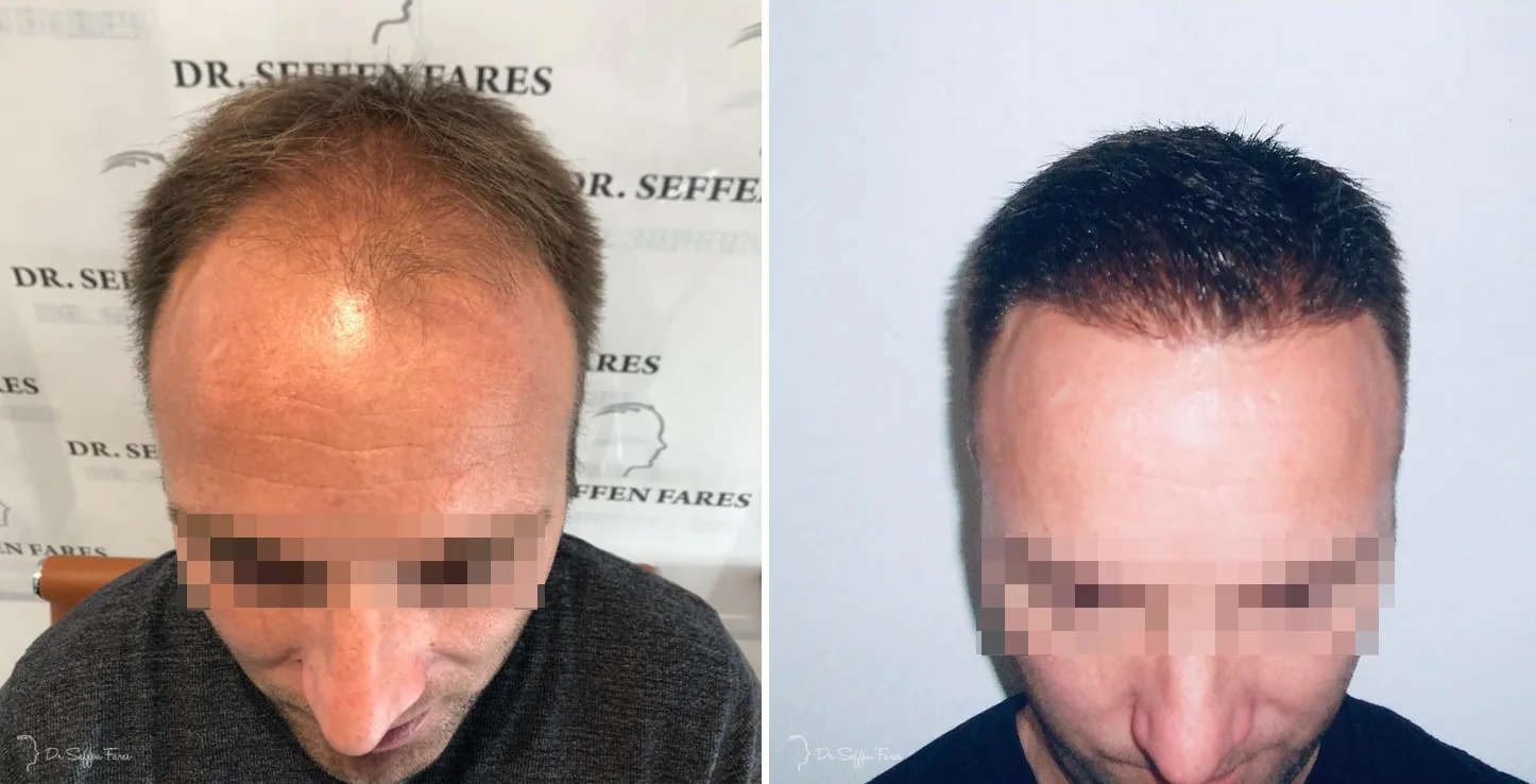 Patient 38, before and after hair transplant, view 1