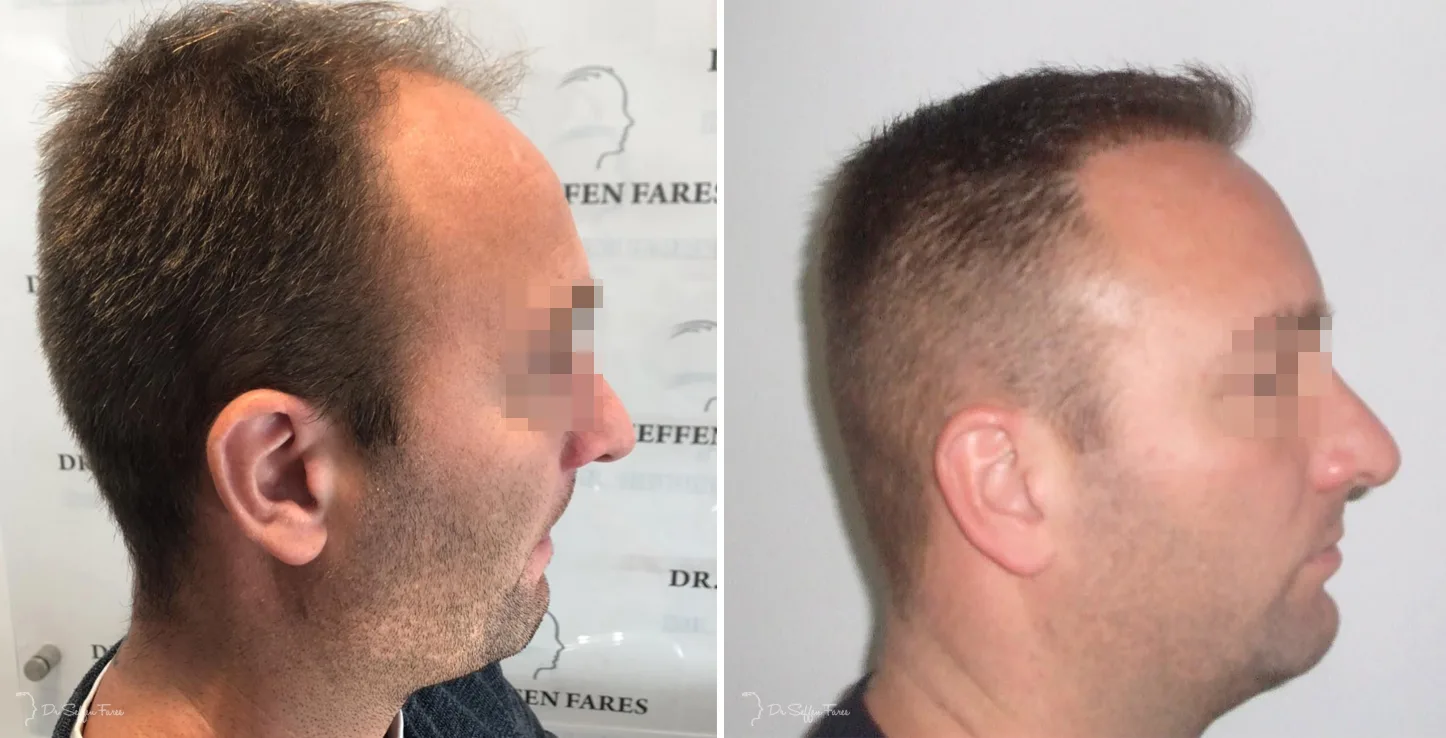 Patient 38, before and after hair transplant, view 2