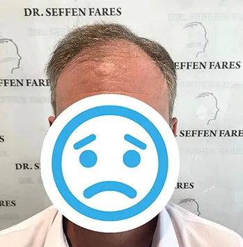 Patient 40, avant greffe de cheveux