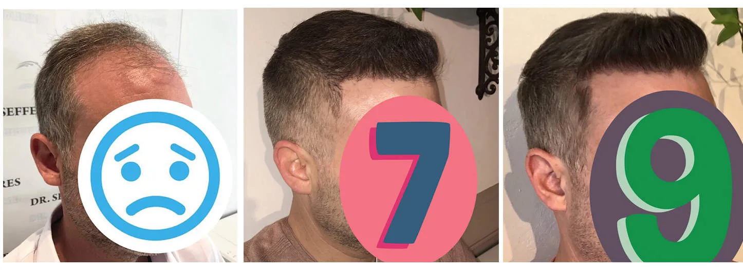 Patient 40, before and after hair transplant, view 3