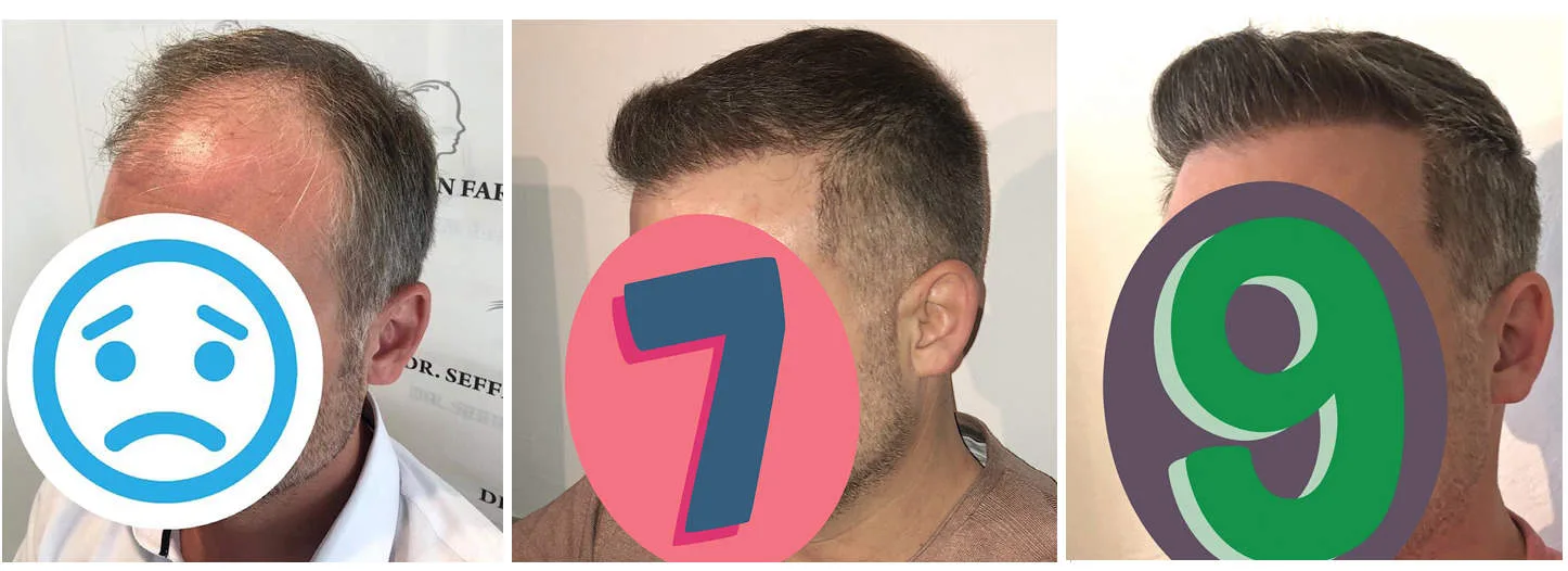 Patient 40, before and after hair transplant, view 1
