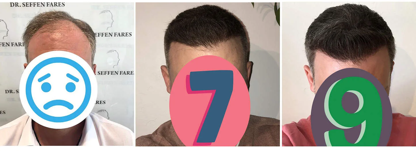 Patient 40, avant et après greffe de cheveux, vue 2