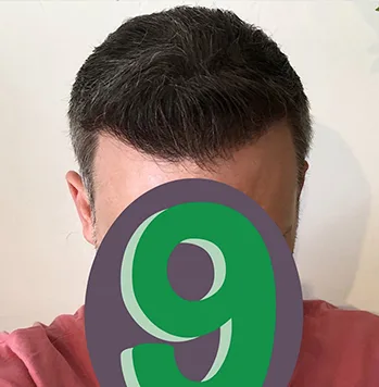 Patient 40, après greffe de cheveux