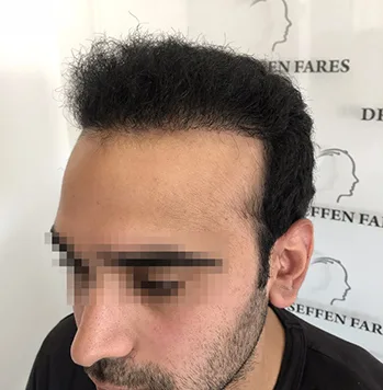 Patient 41, après greffe de cheveux