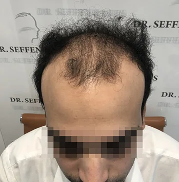 Patient 41, avant greffe de cheveux