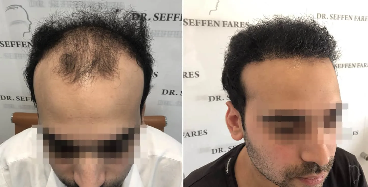 Patient 41, avant et après greffe de cheveux, vue 1