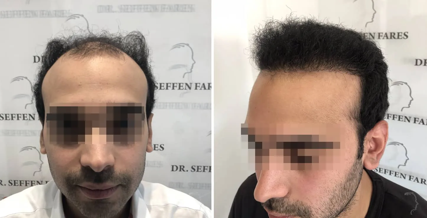 Patient 41, avant et après greffe de cheveux, vue 2