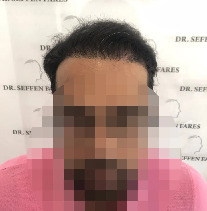 Patient 42, après greffe de cheveux