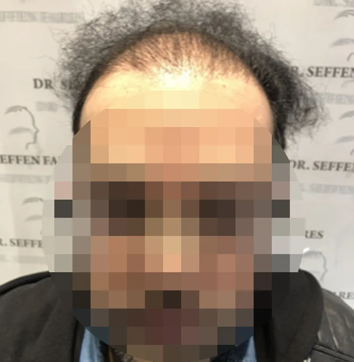 Patient 42, avant greffe de cheveux