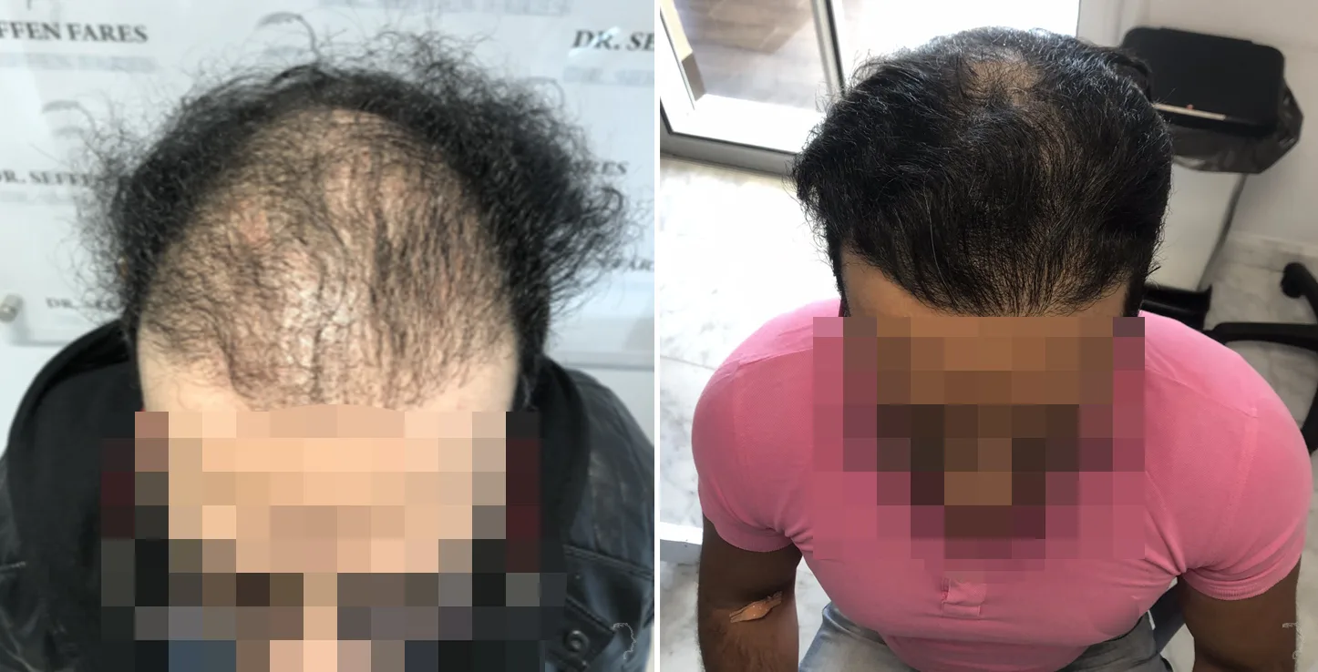 Patient 42, before and after hair transplant, view 2