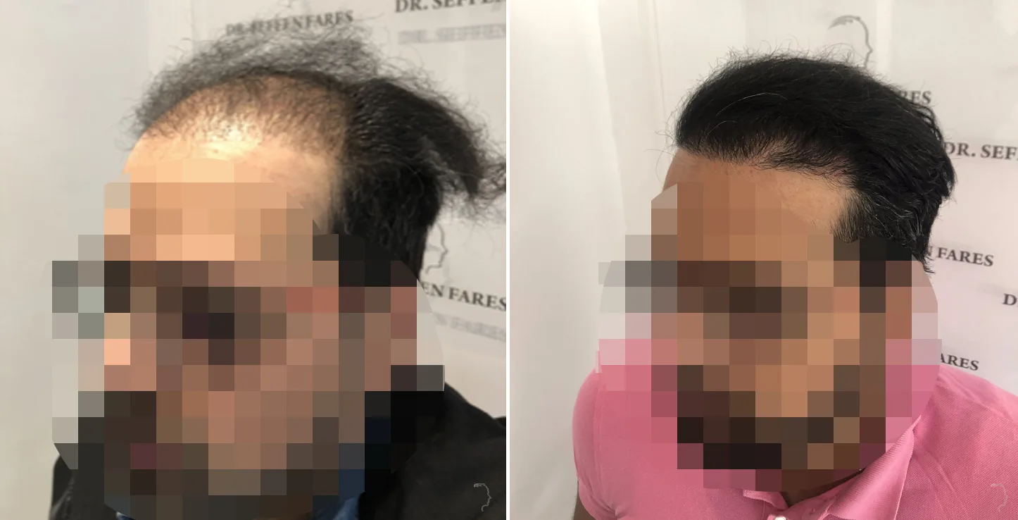 Patient 42, before and after hair transplant, view 4