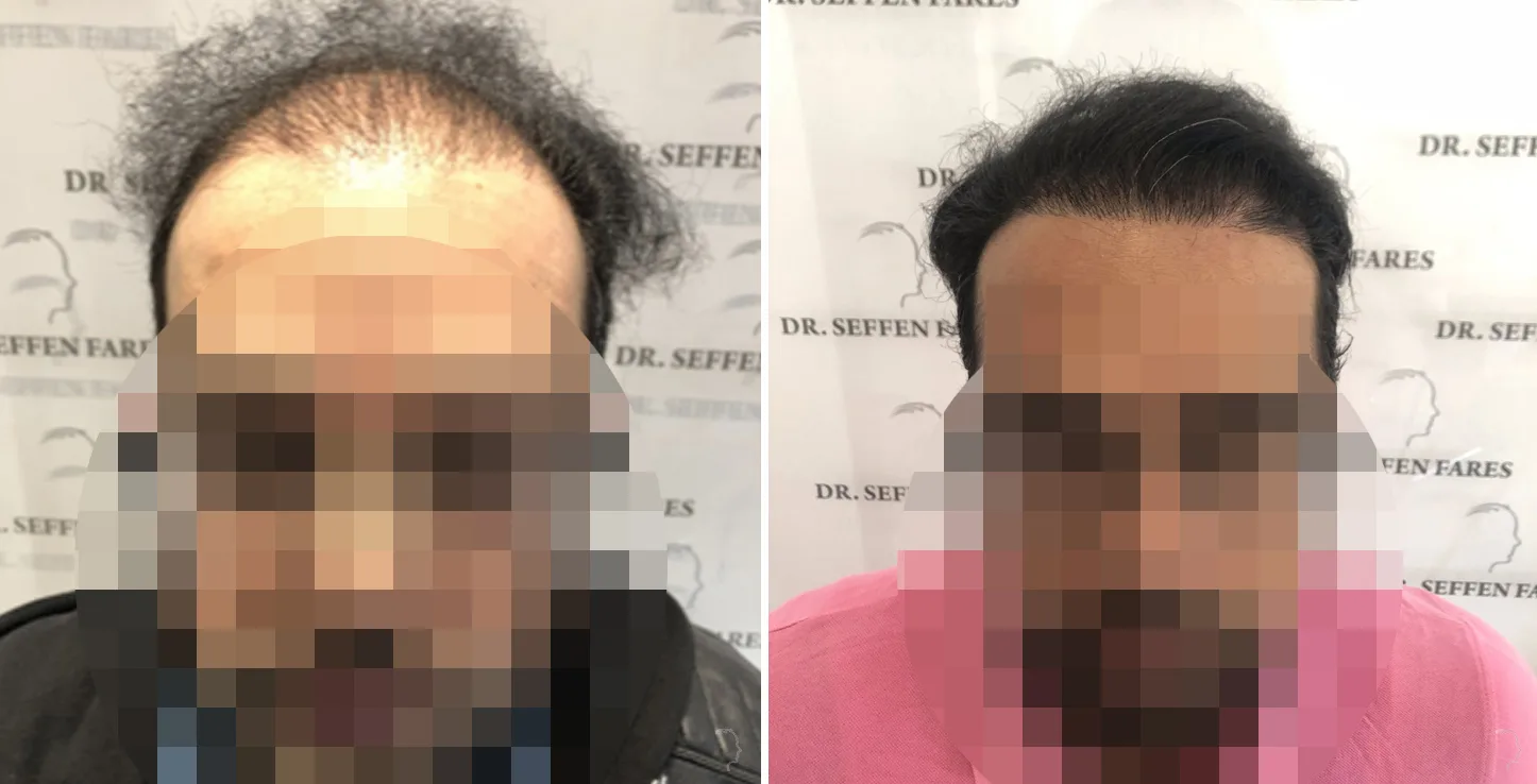 Patient 42, before and after hair transplant, view 1