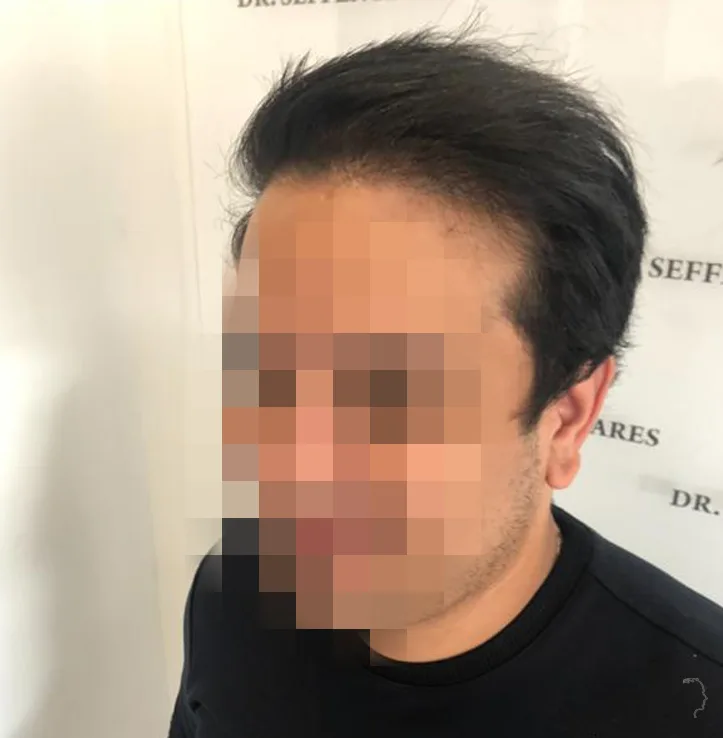 Patient 43, après greffe de cheveux