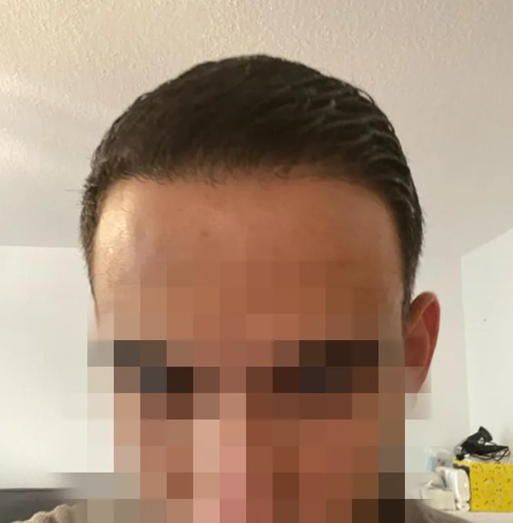Patient 44, après greffe de cheveux