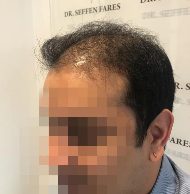 Patient 43, avant greffe de cheveux