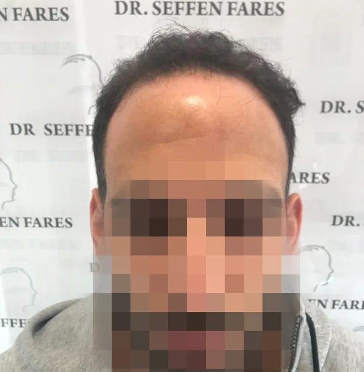 Patient 44, avant greffe de cheveux