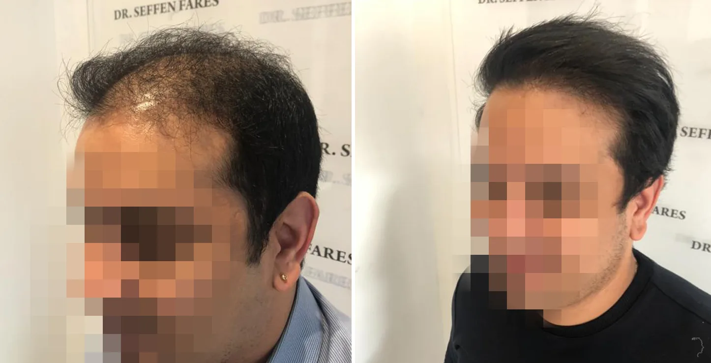 Patient 43, before and after hair transplant, view 2