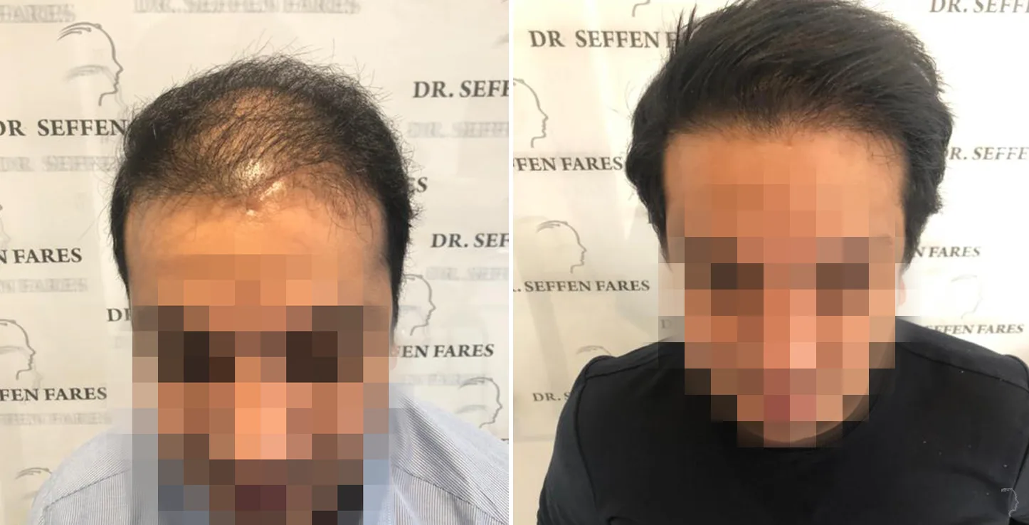Patient 43, before and after hair transplant, view 1