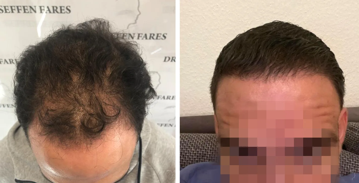 Patient 44, before and after hair transplant, view 2