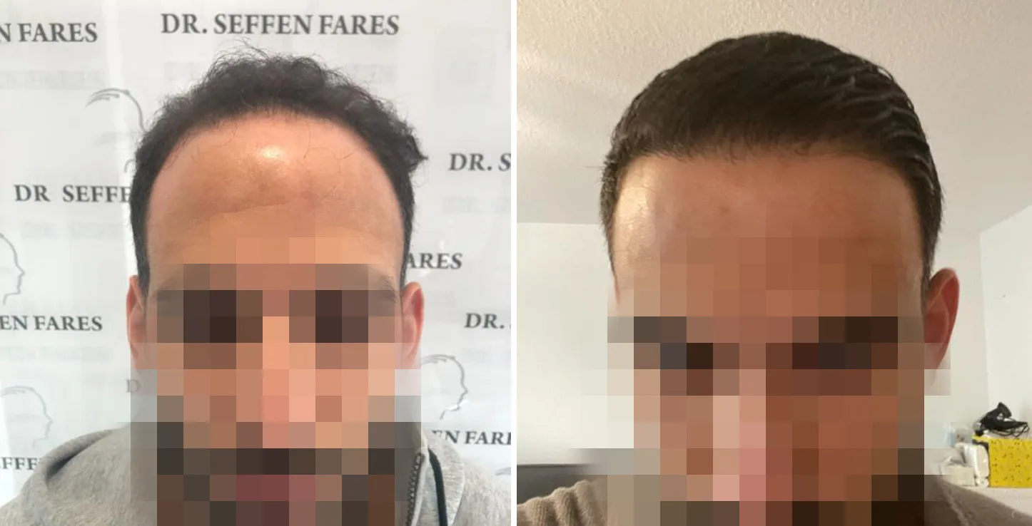 Patient 44, before and after hair transplant, view 1