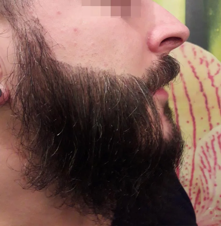 Patient 45, after hair transplant