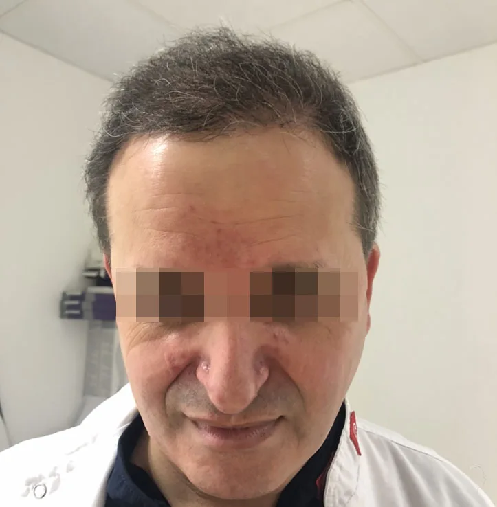 Patient 46, après greffe de cheveux