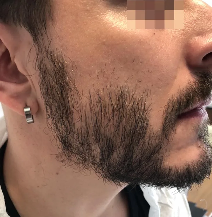 Patient 45, avant greffe de cheveux