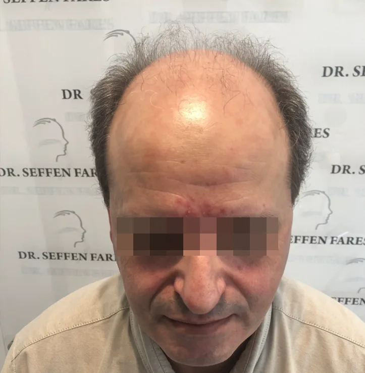 Patient 46, avant greffe de cheveux