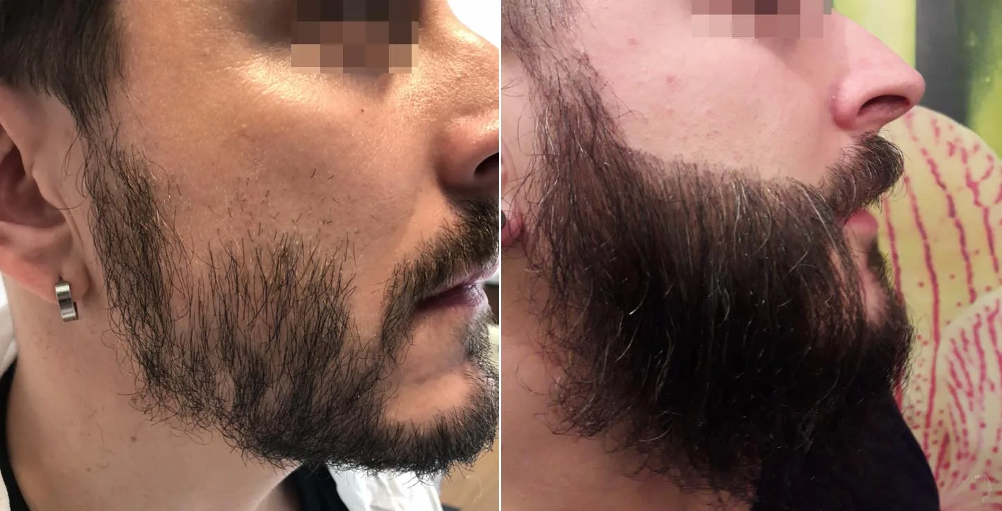 Patient 45, before and after hair transplant, view 1