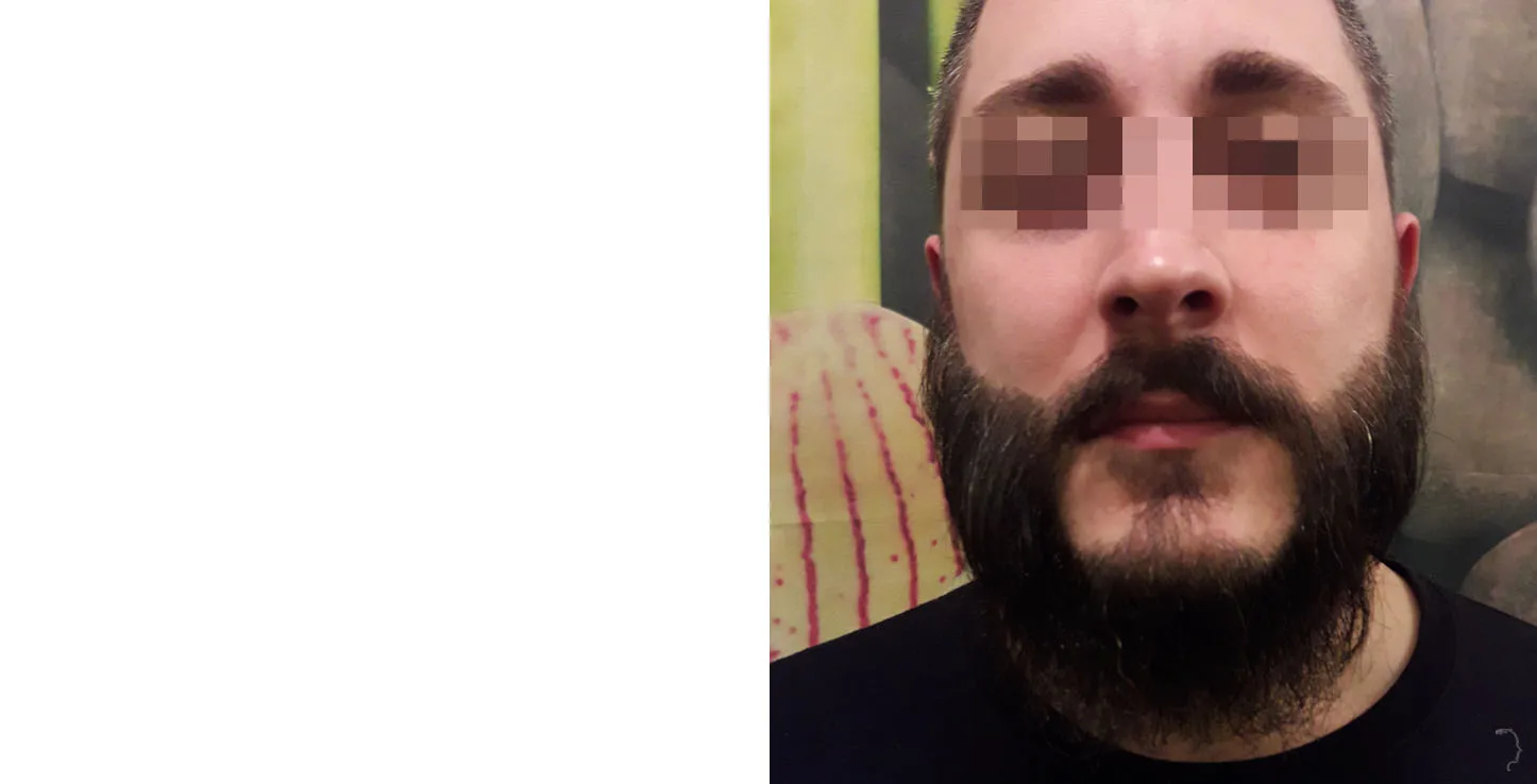 Patient 45, before and after hair transplant, view 3