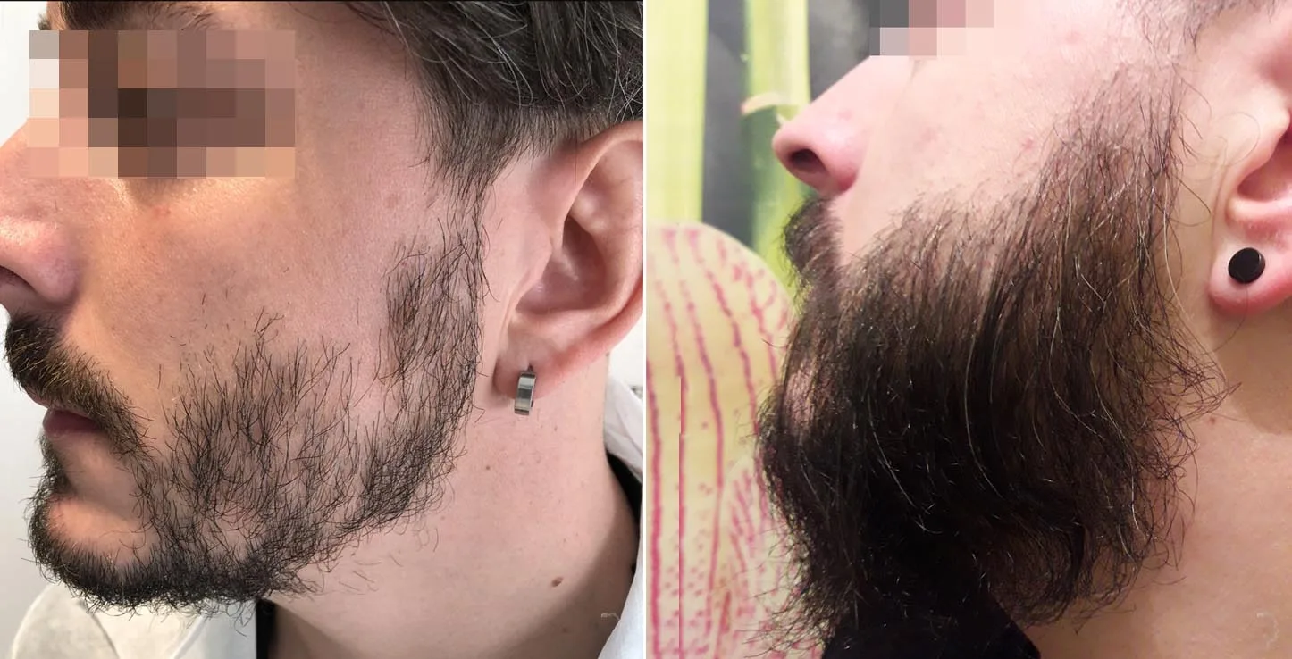 Patient 45, before and after hair transplant, view 2