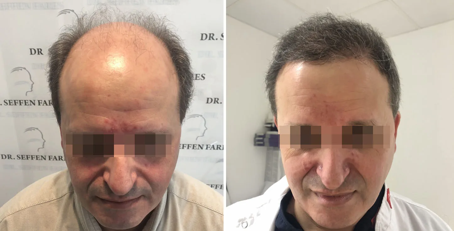 Patient 46, before and after hair transplant, view 1