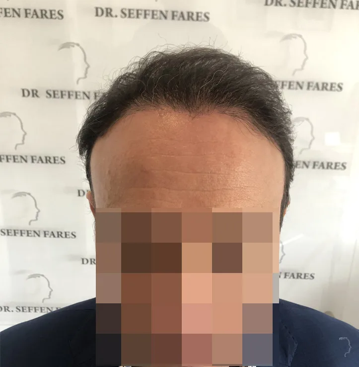 Patient 47, après greffe de cheveux
