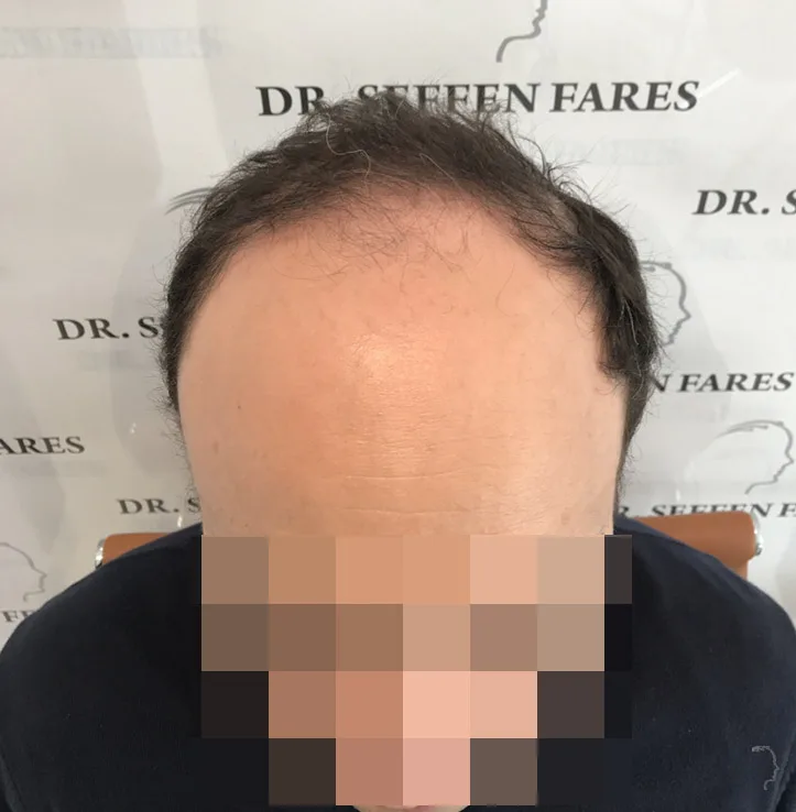 Patient 47, avant greffe de cheveux