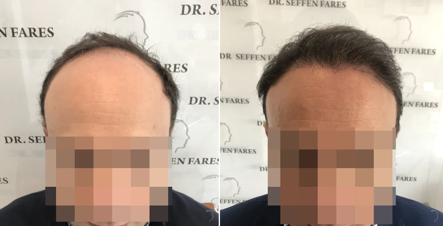 Patient 47, before and after hair transplant, view 1