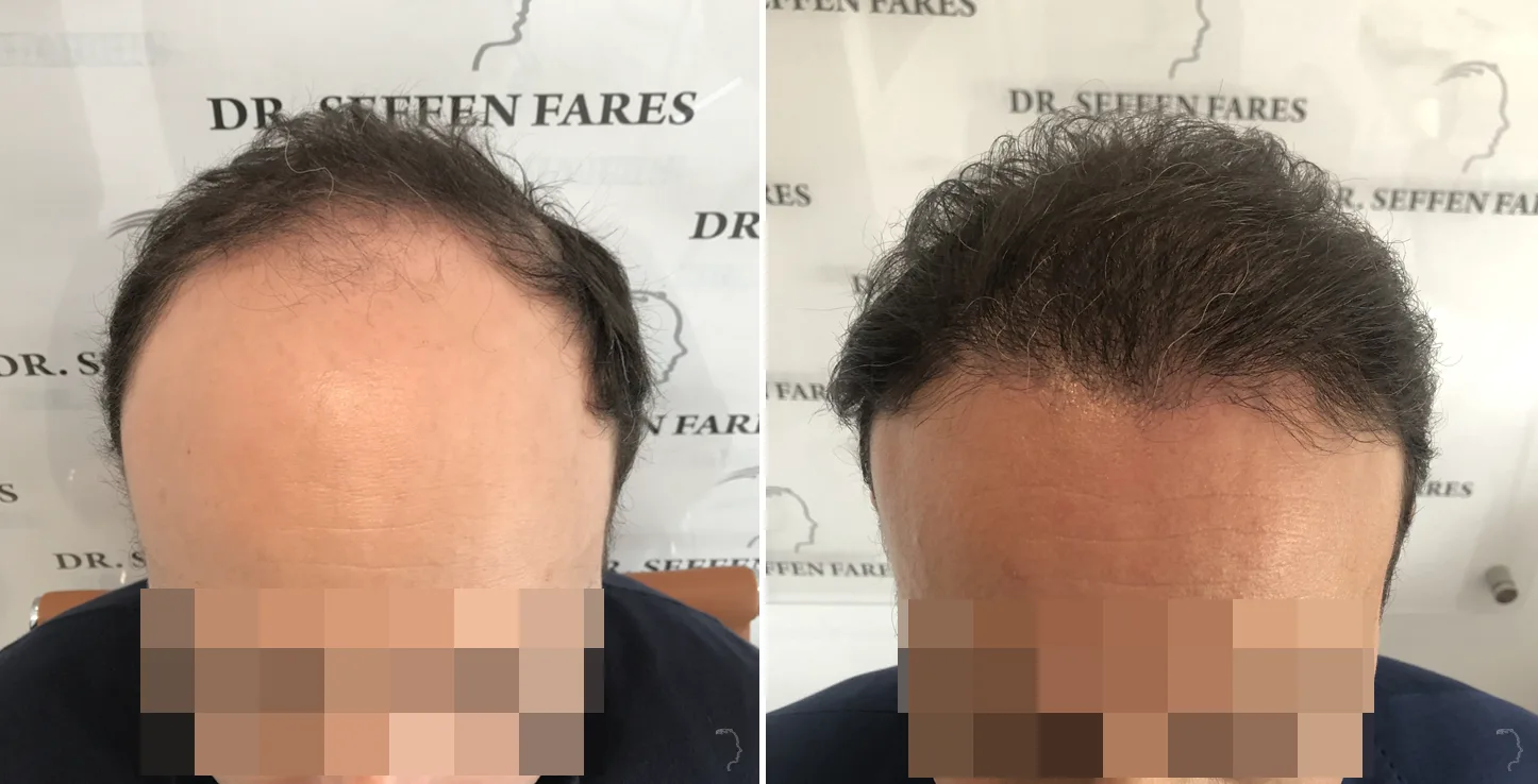 Patient 47, before and after hair transplant, view 4
