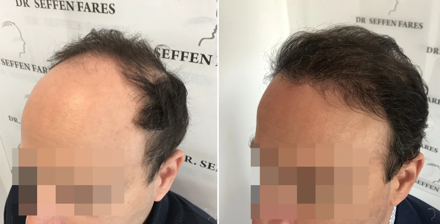 Patient 47, before and after hair transplant, view 3
