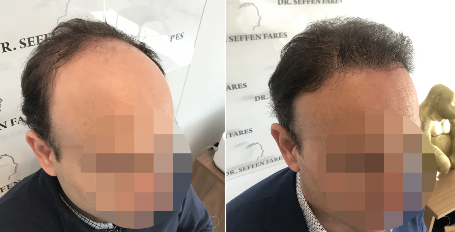 Patient 47, before and after hair transplant, view 2
