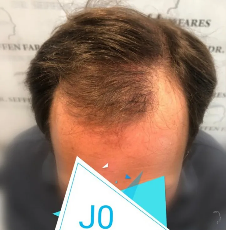 Patient 49, avant greffe de cheveux