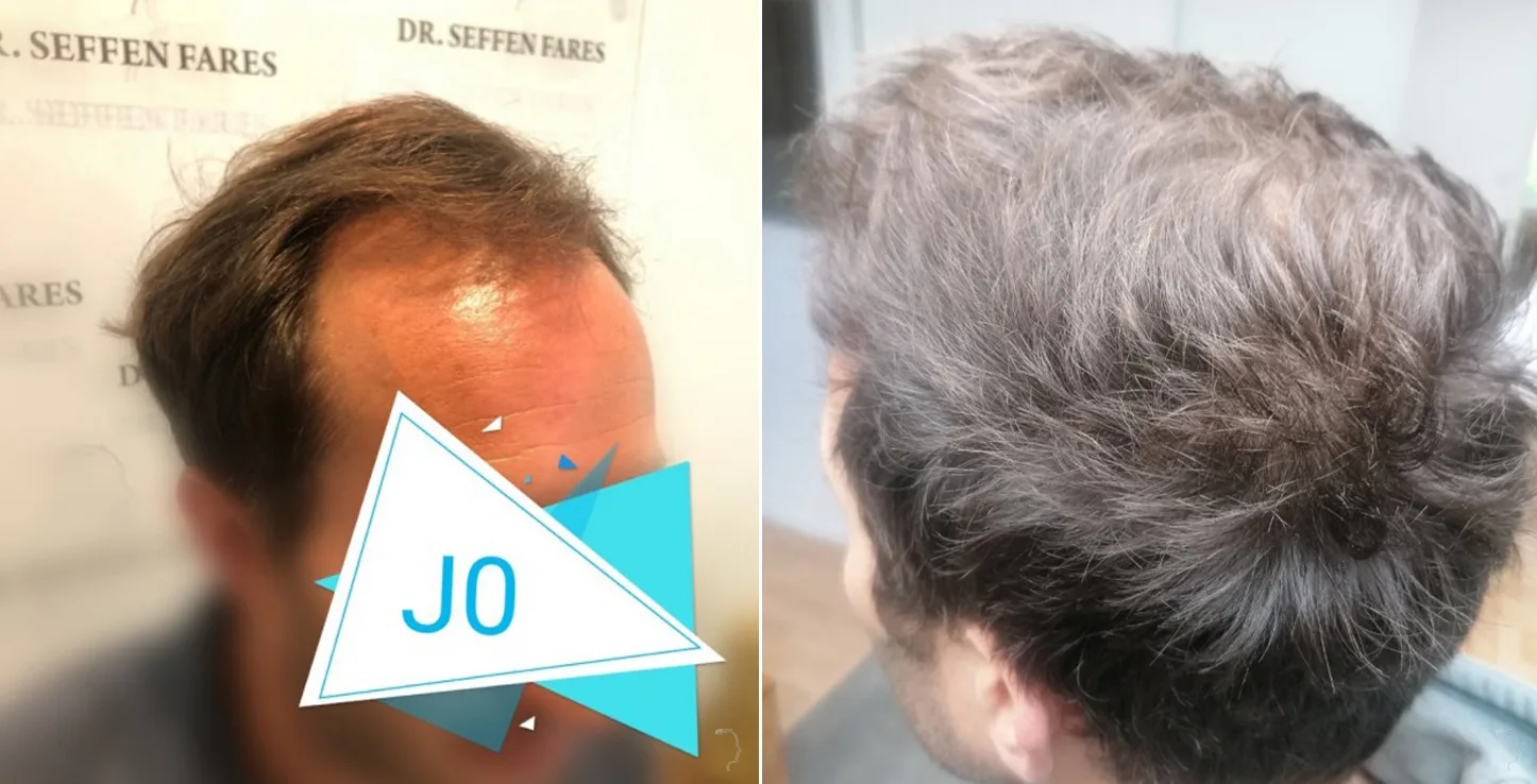 Patient 48, before and after hair transplant, view 2