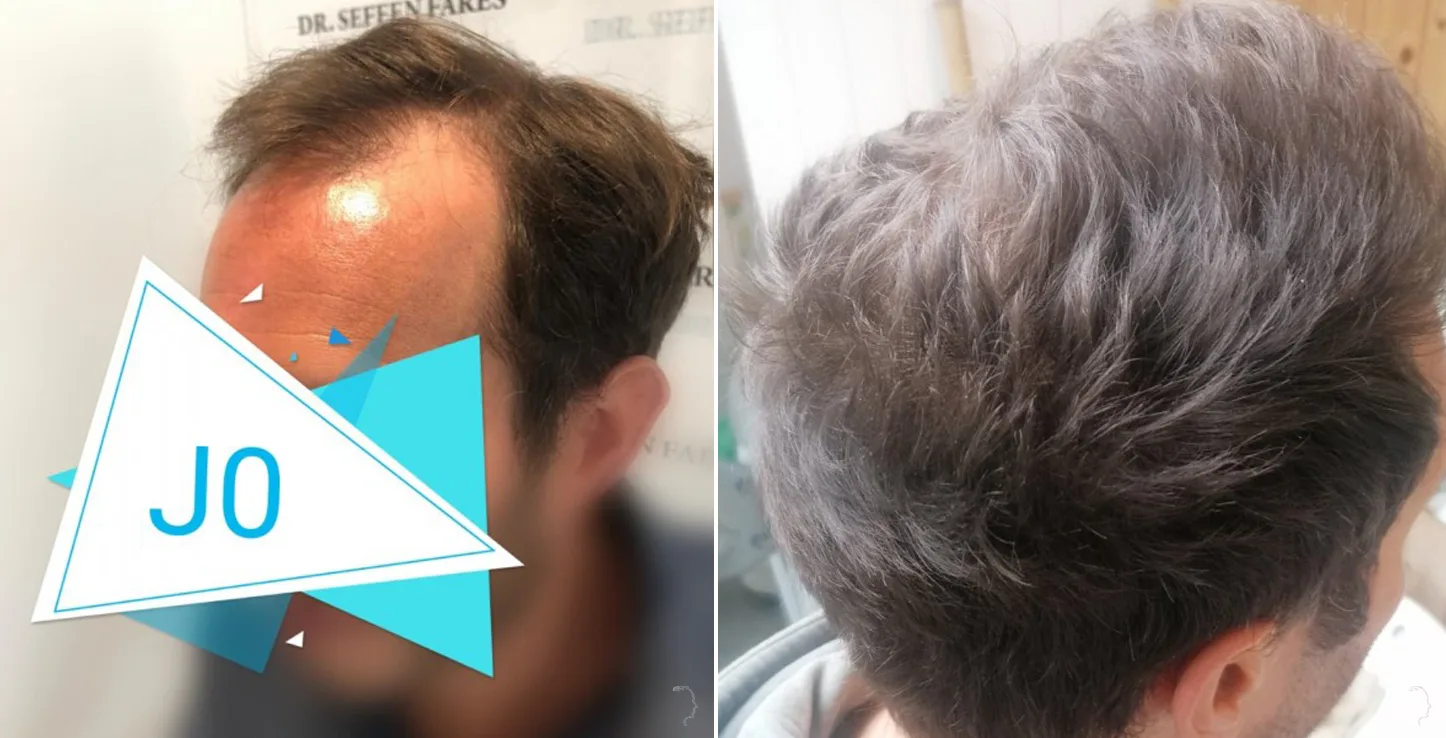 Patient 48, before and after hair transplant, view 3