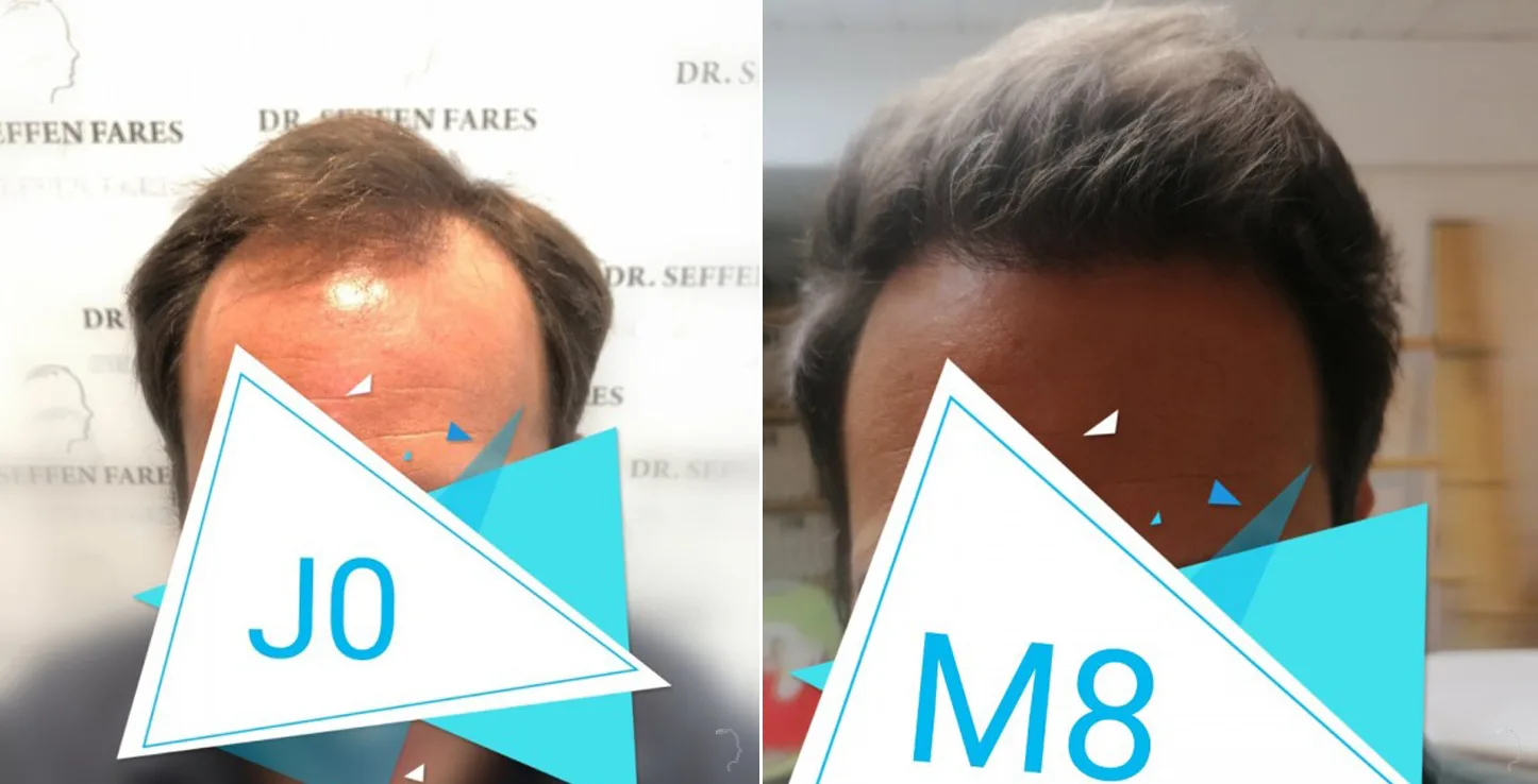 Patient 48, before and after hair transplant, view 1