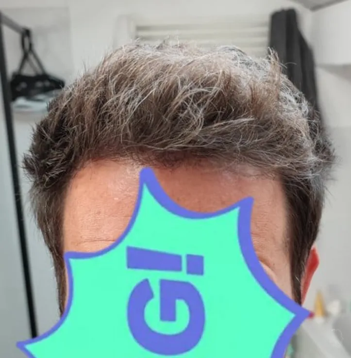 Patient 49, après greffe de cheveux