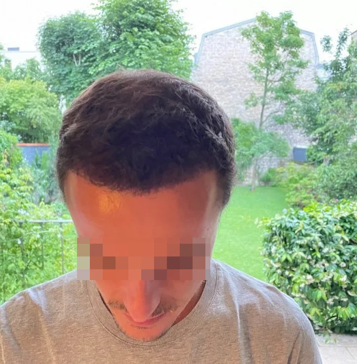 Patient 50, après greffe de cheveux
