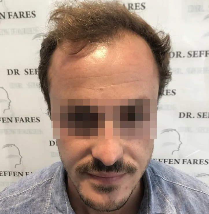 Patient 50, avant greffe de cheveux