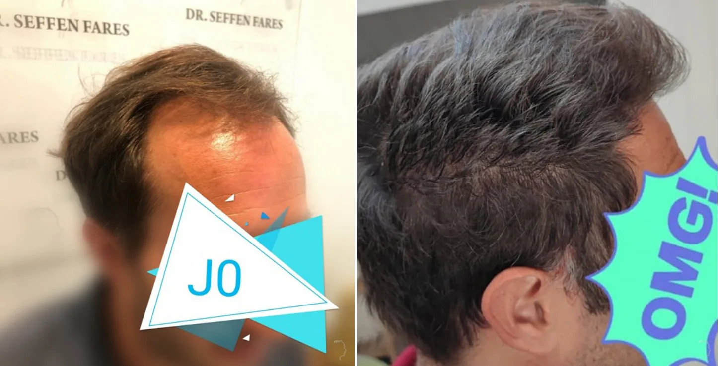 Patient 49, before and after hair transplant, view 2